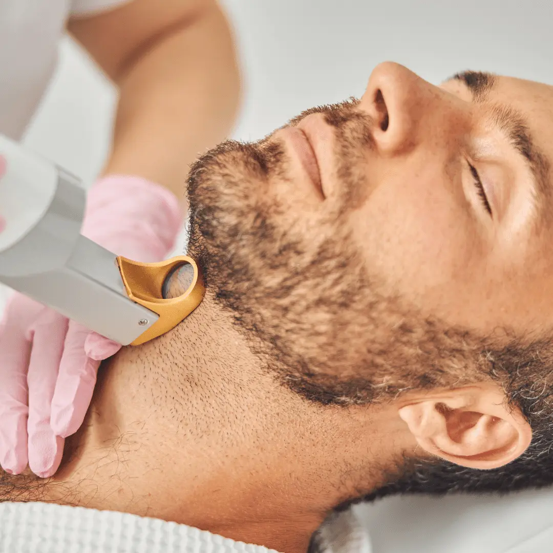 Depilação a Laser Barba Bigode Contagem
