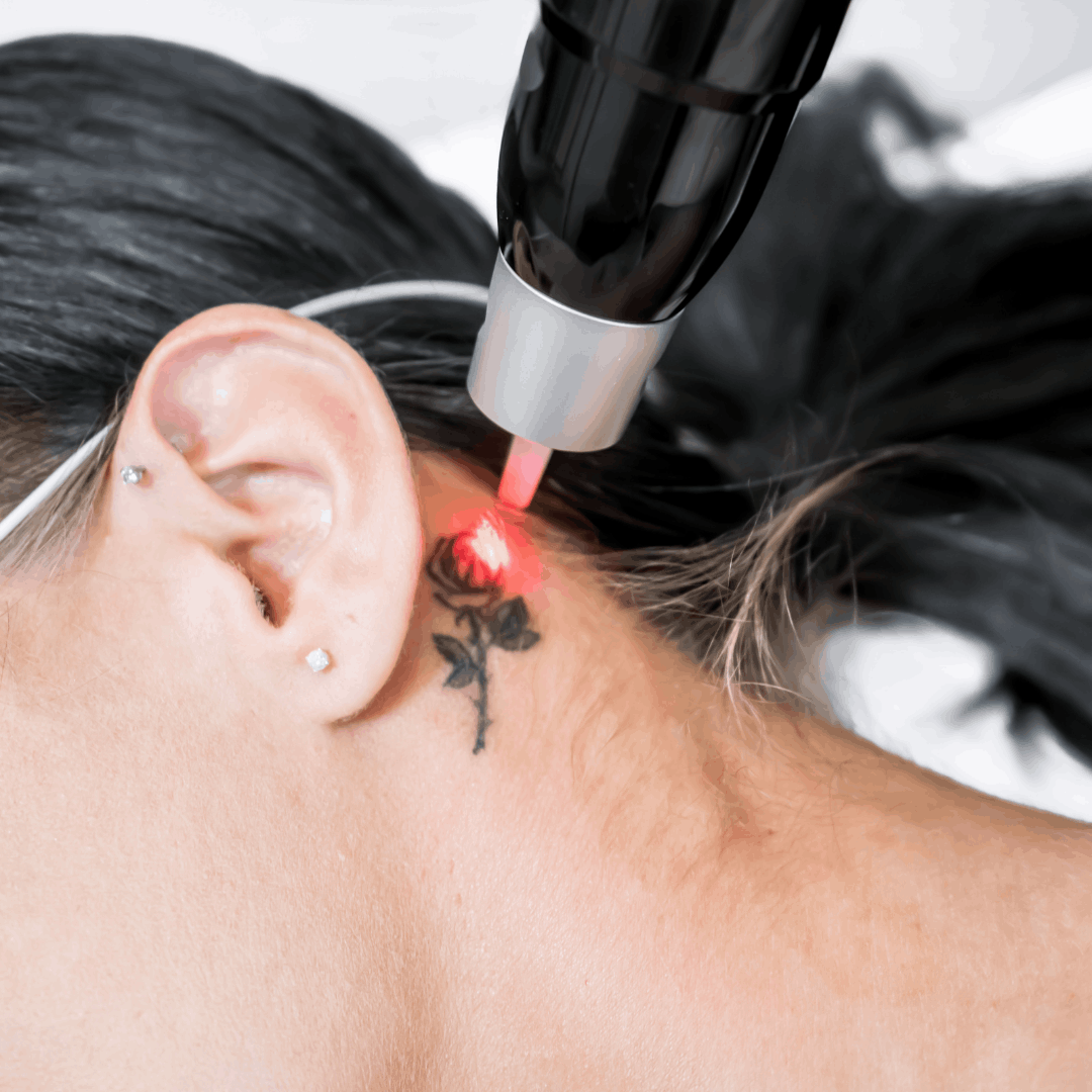 Remoção e Correção de Micropigmentação de Sobrancelhas Contagem