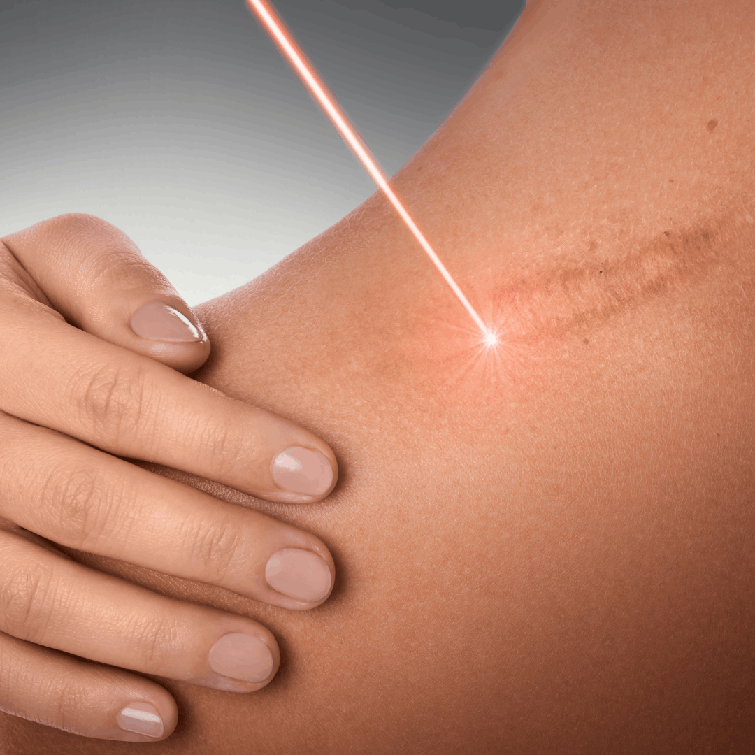 Remoção e Correção de Micropigmentação de Sobrancelhas Contagem